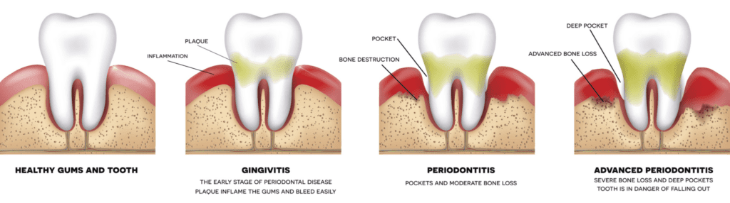 periodontal therapy from your dentist in Morristown, NJ