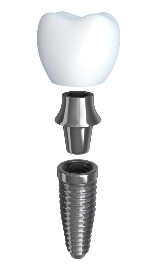 affordable dental implants in Morristown, NJ 