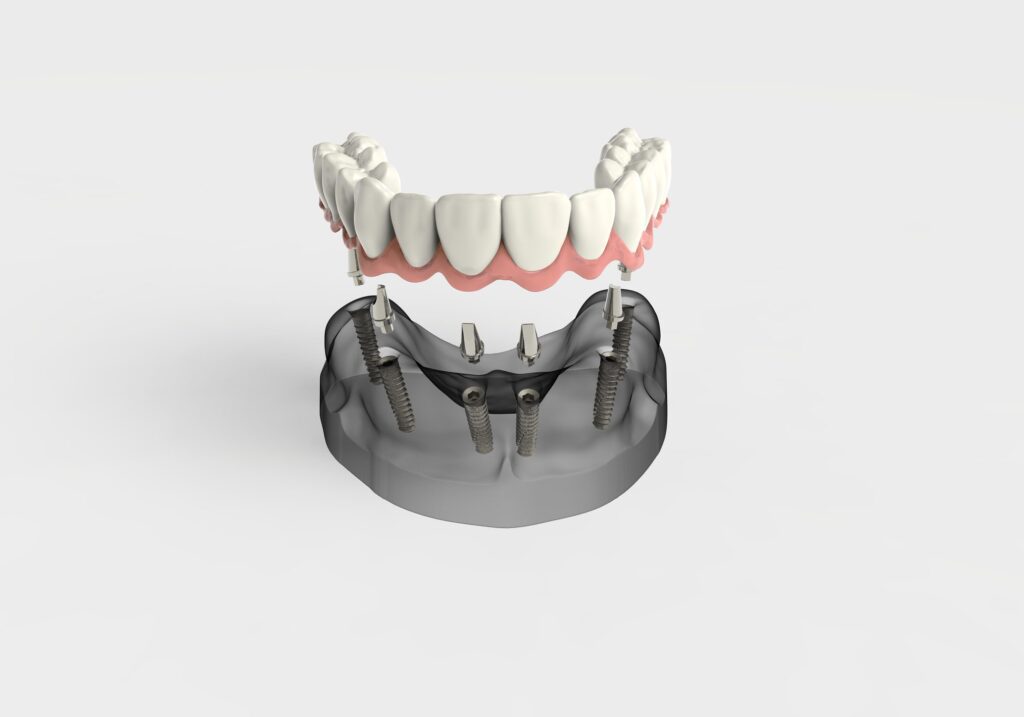 inexpensive dental implants in Morristown, NJ