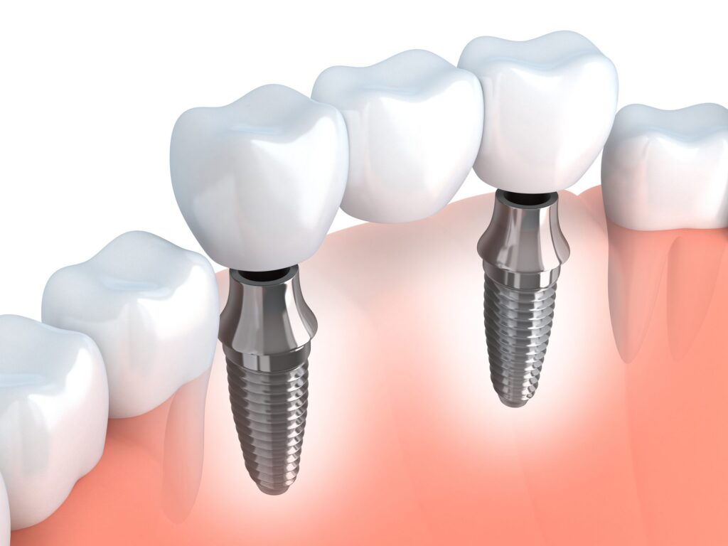 affordable dental implants in Morristown New Jersey