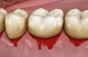 treat bleeding gums promptly in Morristown New Jersey