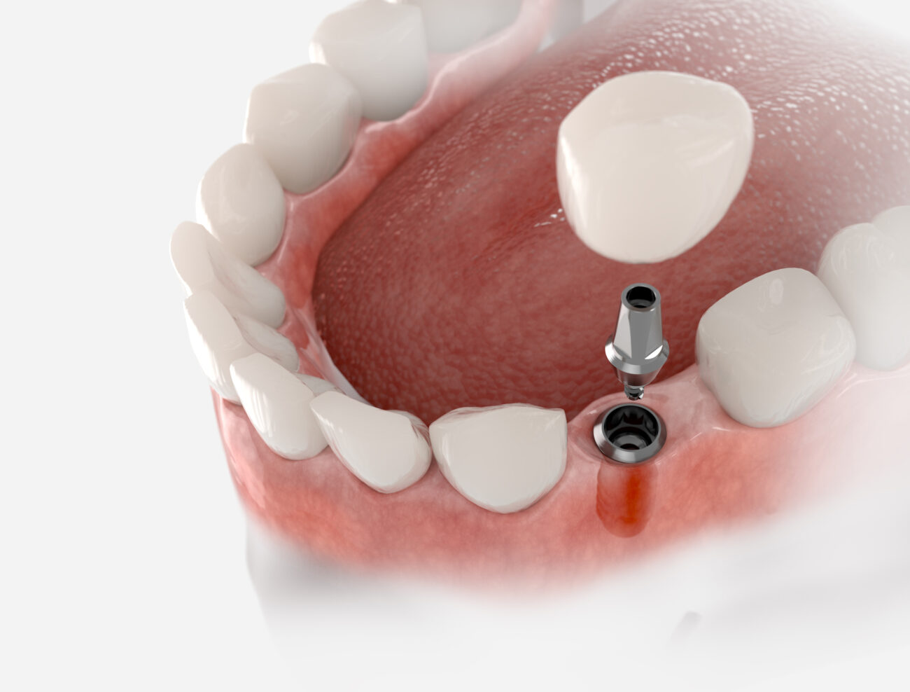 single tooth implant in Morristown