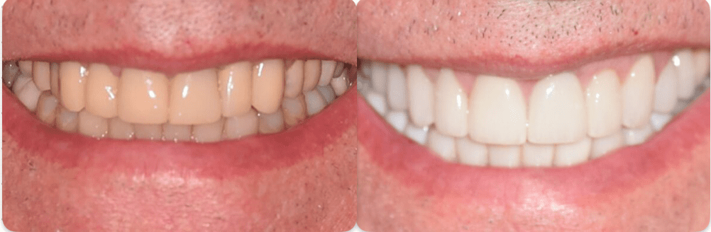 dental crown treatment in morristown, new jersey