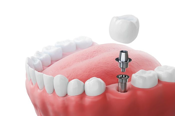 replacing missing teeth with dental implants