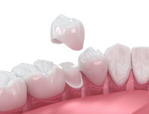 When a dental crown comes off, the underlying tooth becomes exposed and vulnerable to further damage, discomfort, and infection.