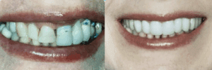 smile makeover transformation