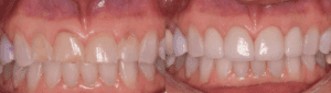 professional teeth whitening in morristown, new jersey