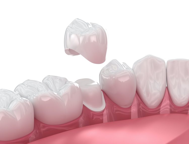 We’re dedicated to providing quality dental crowns that benefit your smile long-term, not quick solutions that only last a while.