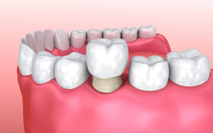 Dental Crown in Morristown NJ
